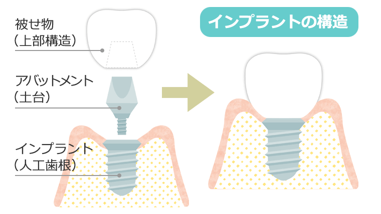 インプラントの構造