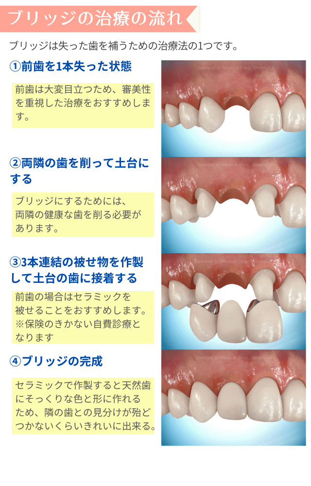 ブリッジの治療の流れ