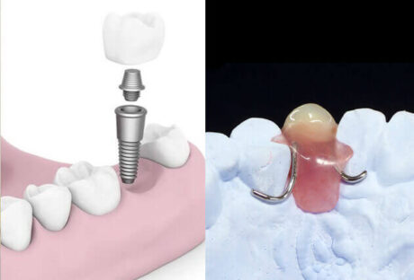 インプラントと入れ歯