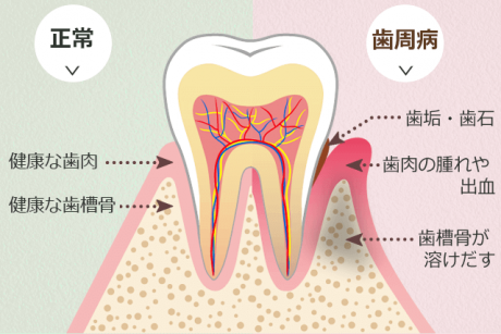 歯周病はどうやってうつるの？治らないの？｜梅田クローバー歯科よくあるご質問