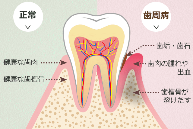 歯周病の説明図
