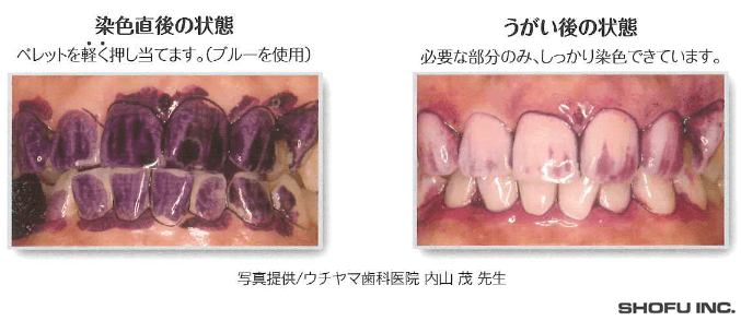 歯石、歯垢の染色