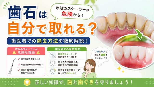 歯石は自分で取れる？市販のスケーラーが危険な理由と歯医者での除去方法を解説