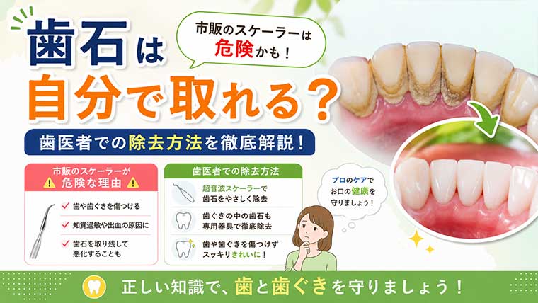 歯石は自分で取れる？市販のスケーラーが危険な理由と歯医者での除去方法を解説