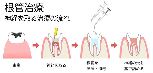 根管治療