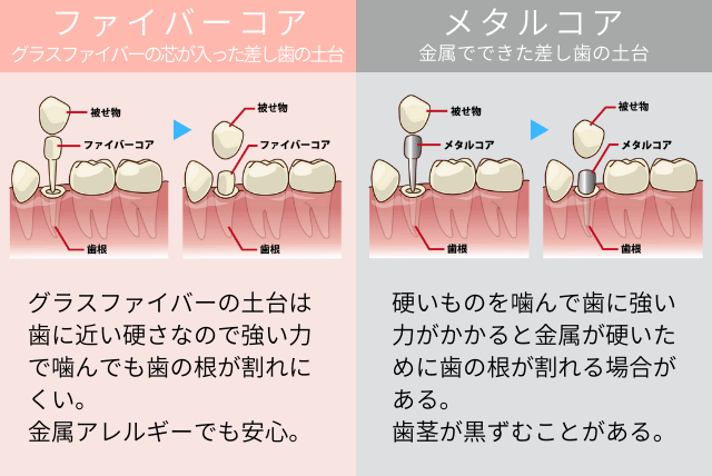 ファイバーコアとメタルコアの違い