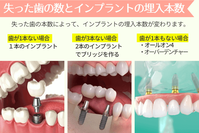 失った歯の数とインプラントの本数