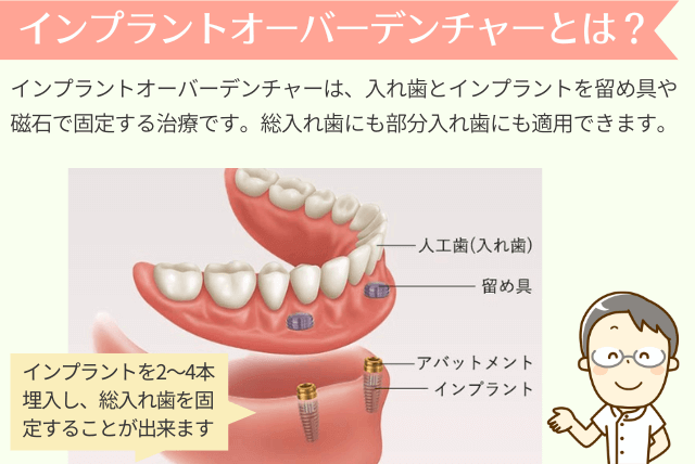 インプラントオーバーデンチャーとは