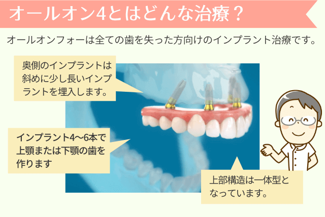 オールオン4とは