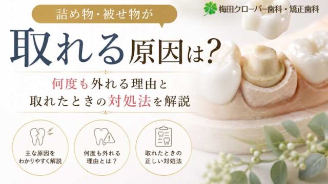 詰め物・被せ物が取れる原因は？何度も外れる理由と取れたときの対処法