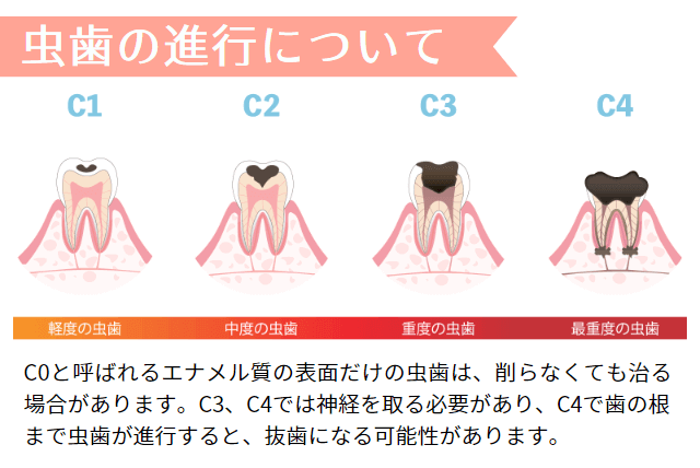 虫歯の進行