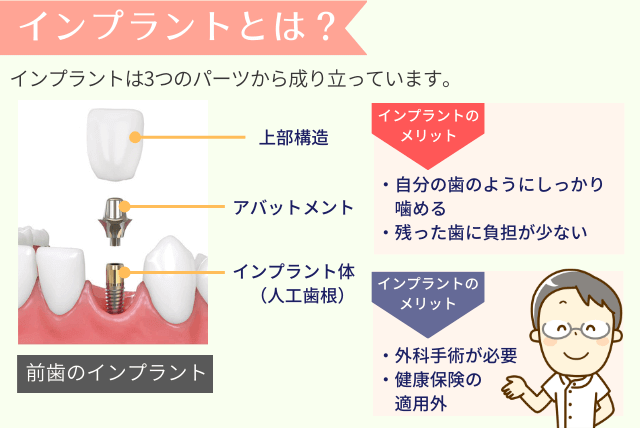 インプラントとは?