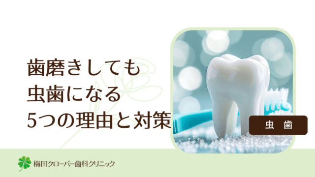 歯磨きしても虫歯になる5つの理由と対策