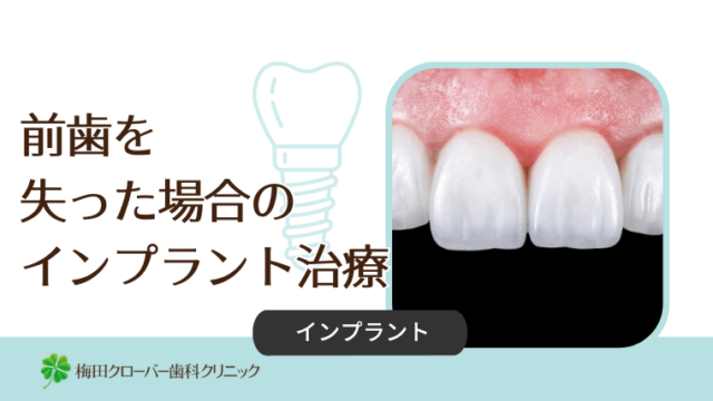 前歯を失った場合のインプラント治療