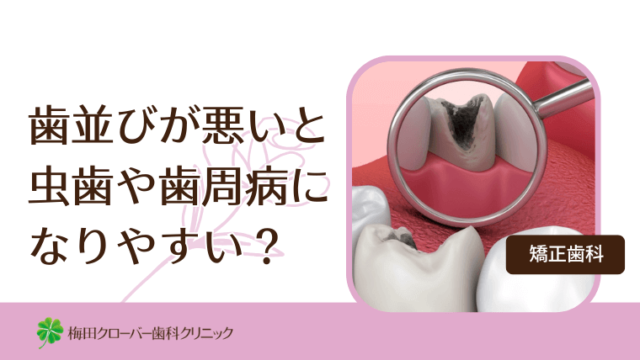 歯並びが悪いと虫歯や歯周病になりやすい？