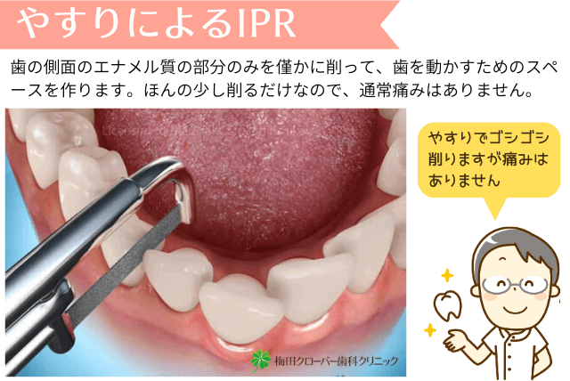 やすりを使用するIPR
