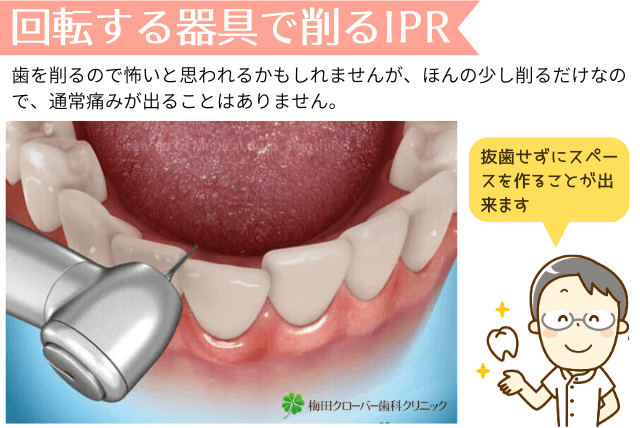 回転する器具で削るIPR