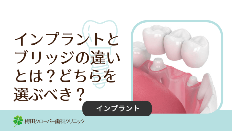 インプラントとブリッジの違いとは?どちらを選ぶべき?