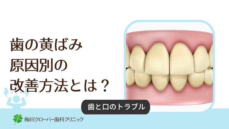 歯の黄ばみ 原因別の改善方法とは？