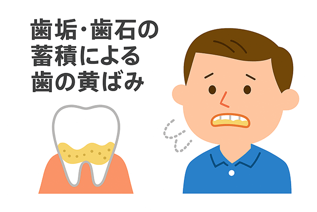 歯垢・歯石による黄ばみ