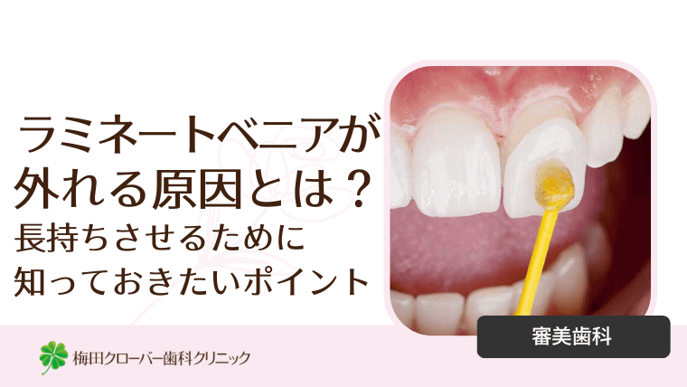 ラミネートベニアが外れる原因とは？