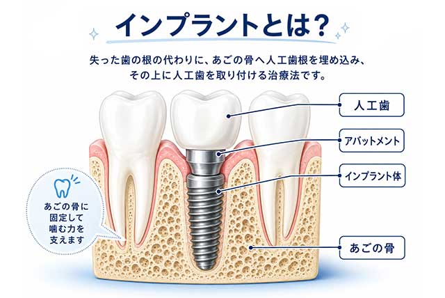 インプラントとは