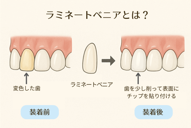 ラミネートベニアとは