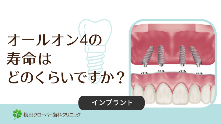 オールオン4の寿命はどのくらいですか?