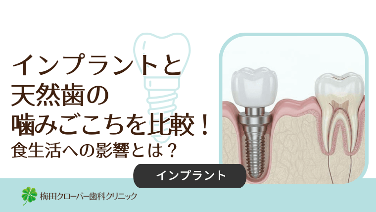 インプラントと天然歯の噛みごこちを比較!