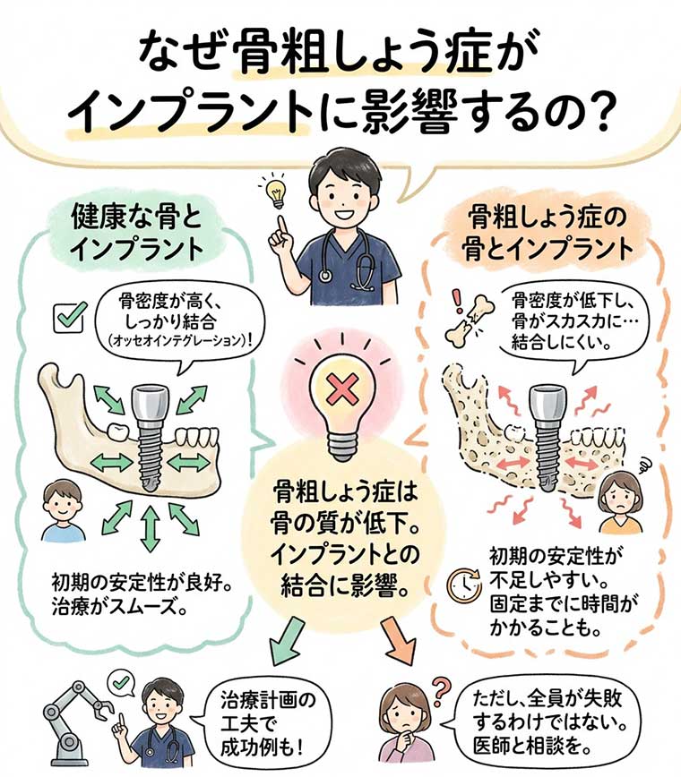 なぜ骨粗しょう症がインプラントに影響するの？の図解