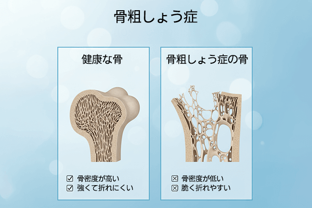 骨粗しょう症