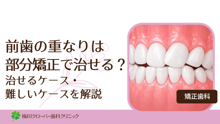 前歯の重なりは部分矯正で治せる？治せるケース・難しいケースを解説