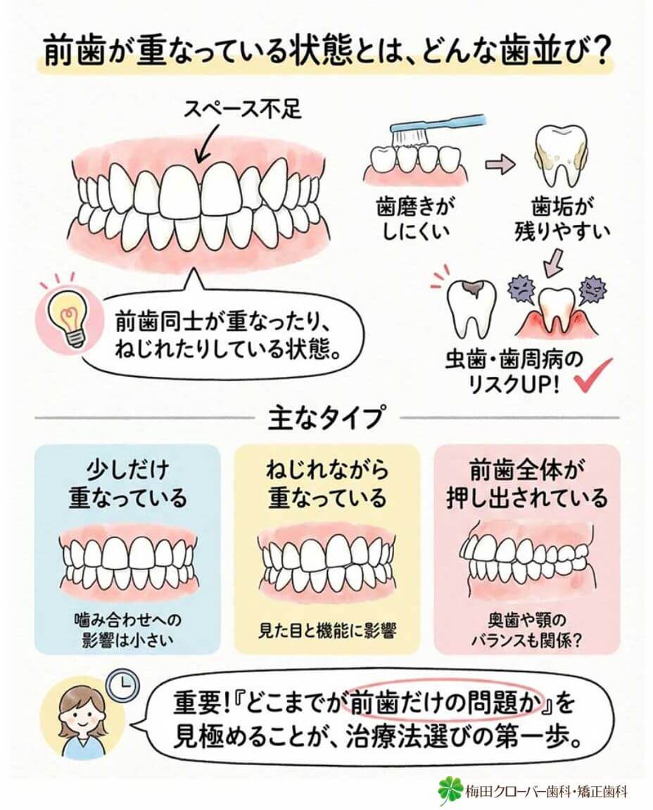 前歯が重なっている状態とは、どんな歯並びを指しますか？の図解