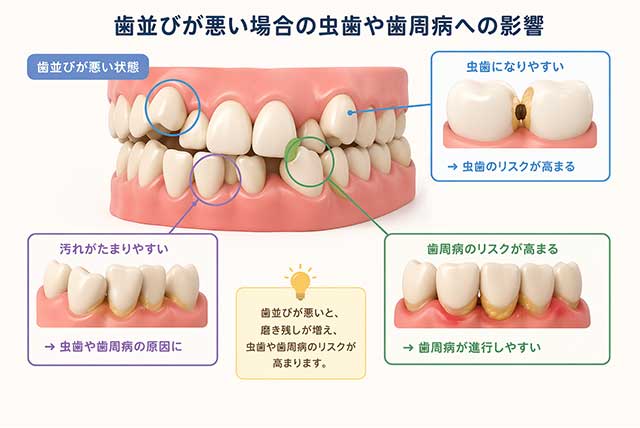 歯並びが悪い場合の虫歯や歯周病への影響