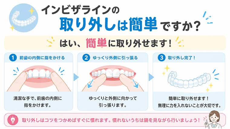 インビザラインの取り外しは簡単ですか？の図解