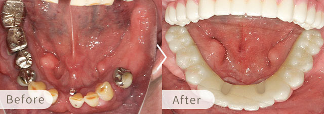 オールオン6・オールオン4の症例