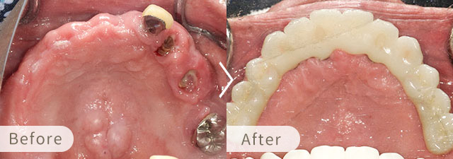 オールオン6・オールオン4の症例