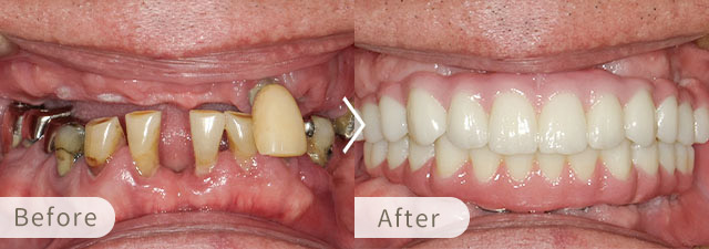 オールオン6・オールオン4の症例