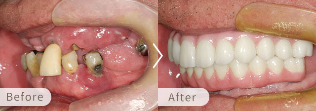 オールオン6・オールオン4の症例