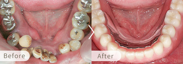 インプラントオーバーデンチャーの症例