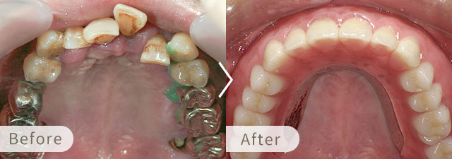 インプラントオーバーデンチャーの症例