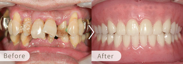 インプラントオーバーデンチャーの症例