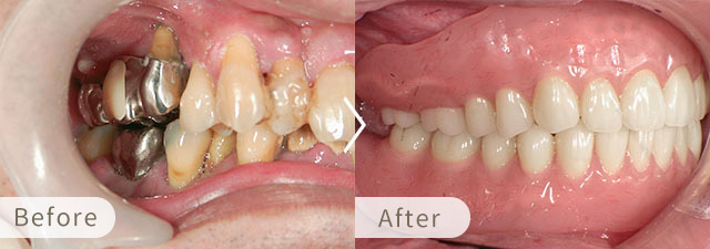 インプラントオーバーデンチャーの症例