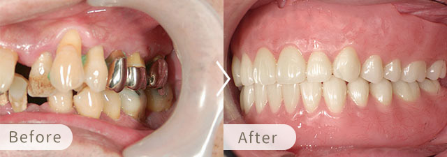 インプラントオーバーデンチャーの症例