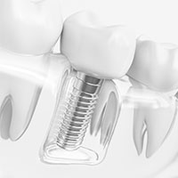 インプラント治療トップ