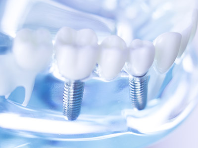 インプラントイメージ