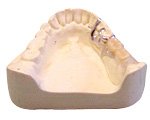 片側処理金属床義歯