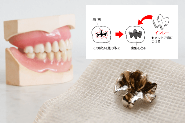 歯医者 詰め物 すぐ 取れ た 料金