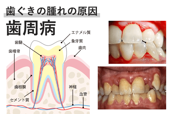 歯周病の場合